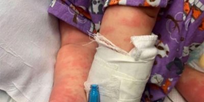 Coronayla birlikte çocukları vuran hastalık ABD’ye sıçradı!