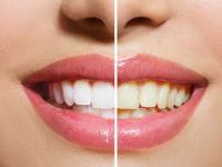 En sağlıklı diş beyazlatma yöntemi nedir?