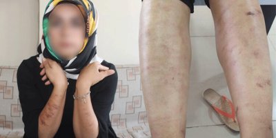 Bir güzellik merkezi skandalı daha! Genç kadının vücudu yandı…