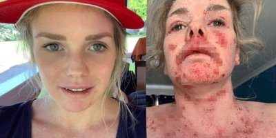 Egzama için krem aldı, hayatını şokunu yaşadı