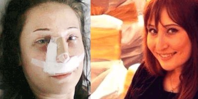 Burun ameliyatı sonrası iki bacağı da kesildi