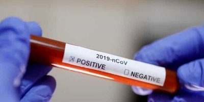 İskele Belediyesi’nde 2 pozitif vaka!