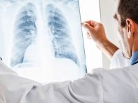 Akciğer kanserini tetikleyen faktörler neler?