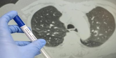 Covid-19 olanlar neden negatif çıkıyor?