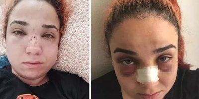 Kadın çalışanın burnunu kıran patrona 4.5 yıla kadar hapis istemi