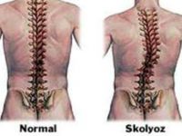 Sırtta düzleşme veya kamburluk skolyoz belirtisi