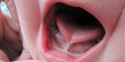 Dil bağı, bebeklerde ciddi gelişim sorunları yaratabilir!