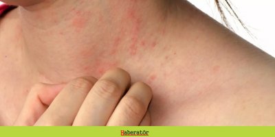 Uyuz vakaları artmaya devam ediyor: Kaşıntı semptomu gösterenler ne yapmalı?