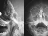 YDÜ Hastanesi’nde, çocuğun burun deliğine sıkışan mıknatısların çıkarılması için yapılan müdahale, ABD'de haber oldu