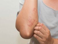 Egzaması olanlar duş jeli kullanmalı mı? Egzamanın belirtileri nelerdir?