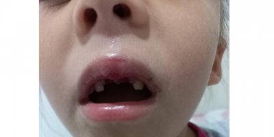 Sınıf arkadaşı darp etti, ön dişlerini kaybetti