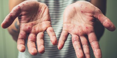 "Kızamık enfeksiyonu için tedbir alalım"