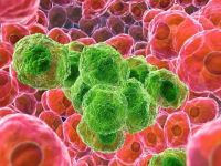 Kanserin 20 ölümcül belirtisi!