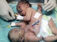 Gazzeli yapışık ikizler Suudi Arabistan'da ameliyatla ayrıldı
