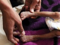 Yemen'de son iki ayda difteri nedeniyle hayatını kaybedenlerin sayısı 48'e yükseldi