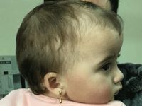 14 aylık bebeğe kafa şekillendirme ameliyatı