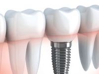 İmplant tedavisinde dijital planlama avantajı