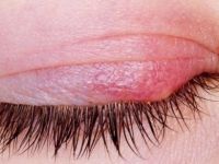 Gözde çıkan arpacığı geçirmenin en hızlı ve doğal yolu