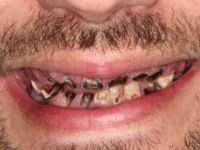 Bu bağımlılık tüm dişlerini paramparça etti!