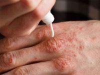 Soğuk havada bol bol su egzamadan koruyor