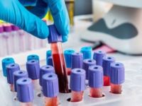 Karaciğer kanserine kanla erken teşhis