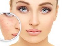 Yüzü kızartan neden: Rozasea